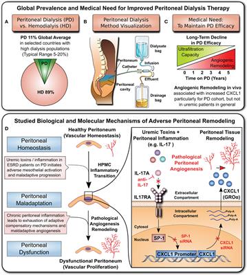 Angiogenic Role of Mesothelium-Derived Chemokine CXCL1 During Unfavorable Peritoneal Tissue Remodeling in Patients Receiving Peritoneal Dialysis as Renal Replacement Therapy